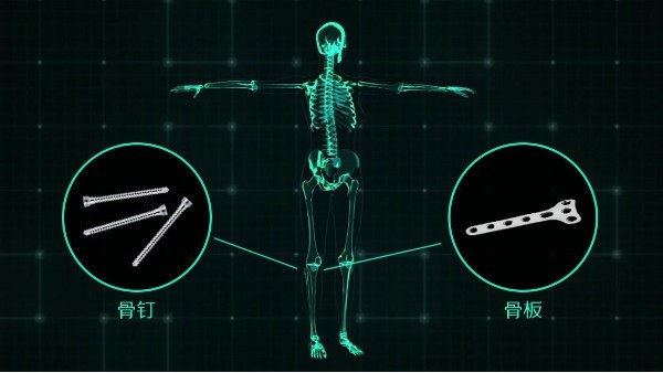 鎂夢(mèng)成真 《宜安科技醫用鎂骨釘獲歐盟CE認證》